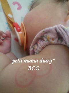 BCG注射
