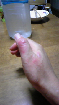 やけど 2008/05/17 20:53:37