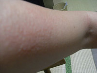 日光・紫外線アレルギー写真(3回目）