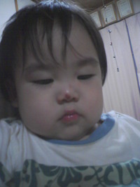 初ケガ 2008/06/10 21:27:14