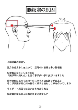 天城流湯治法　脳梗塞