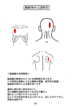 天城流湯治法　言語障害