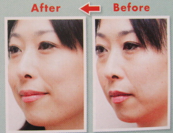 アンプルールでたるみが1週間で劇的解消画像あり